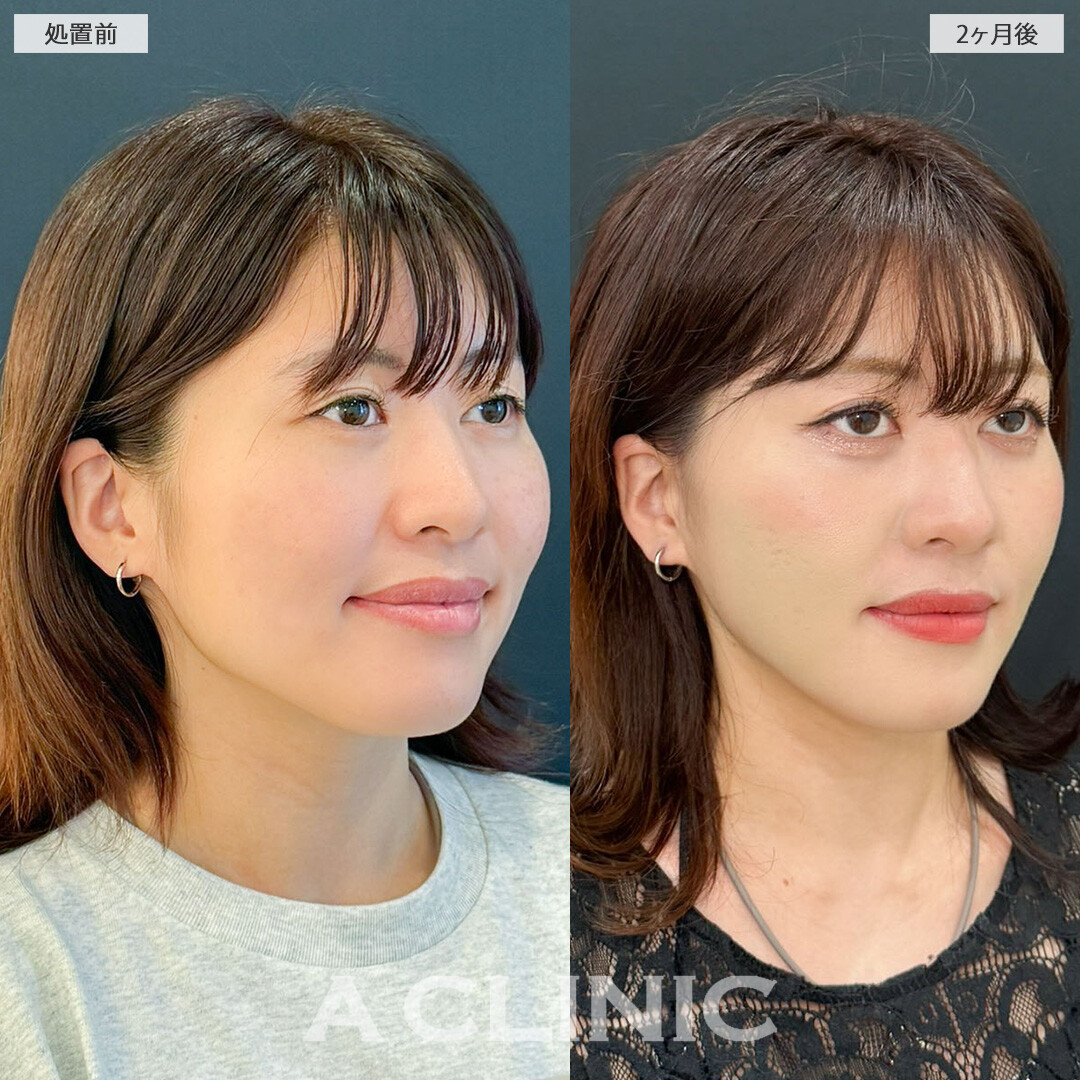 A式美肌たるみ切開と1day小顔脂肪吸引で余白が無くなりスッキリ小顔に！こちら処置前と2ヶ月後の症例です(20代女性）