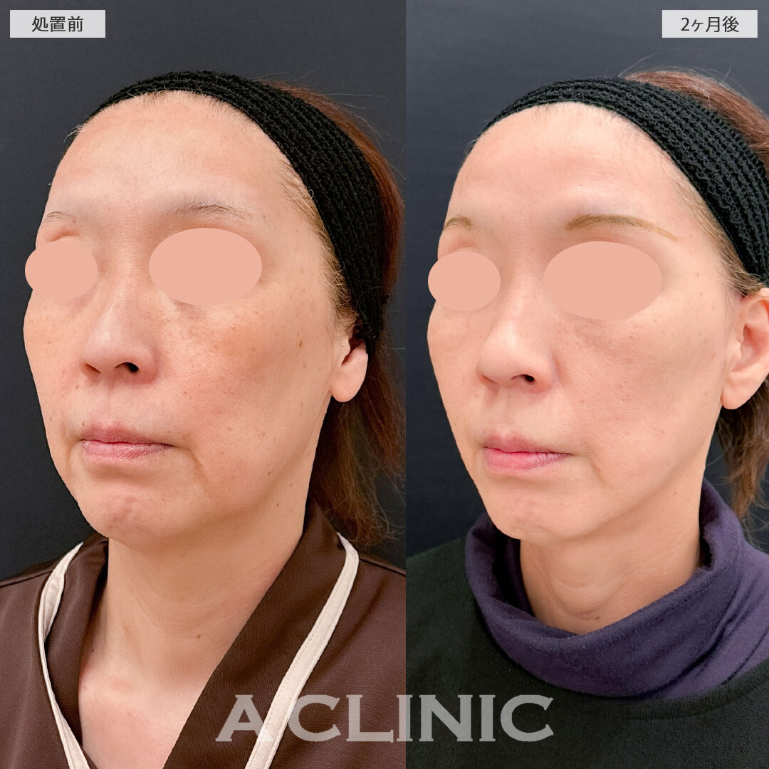 【直後の傷跡あり】A式美肌たるみ切開と1day小顔脂肪吸引でたるみも口横のポニョも改善されました！こちら処置前と2ヶ月後の症例です(50代女性)