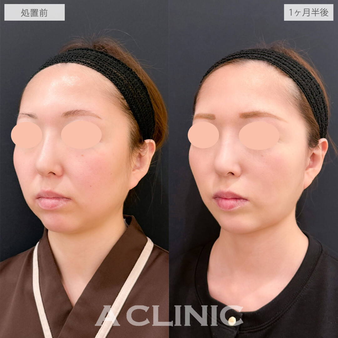 A式美肌たるみ切開と1day小顔脂肪吸引でたるみも脂肪も一掃できます！こちら処置前と1ヶ月半後の症例です(30代女性)