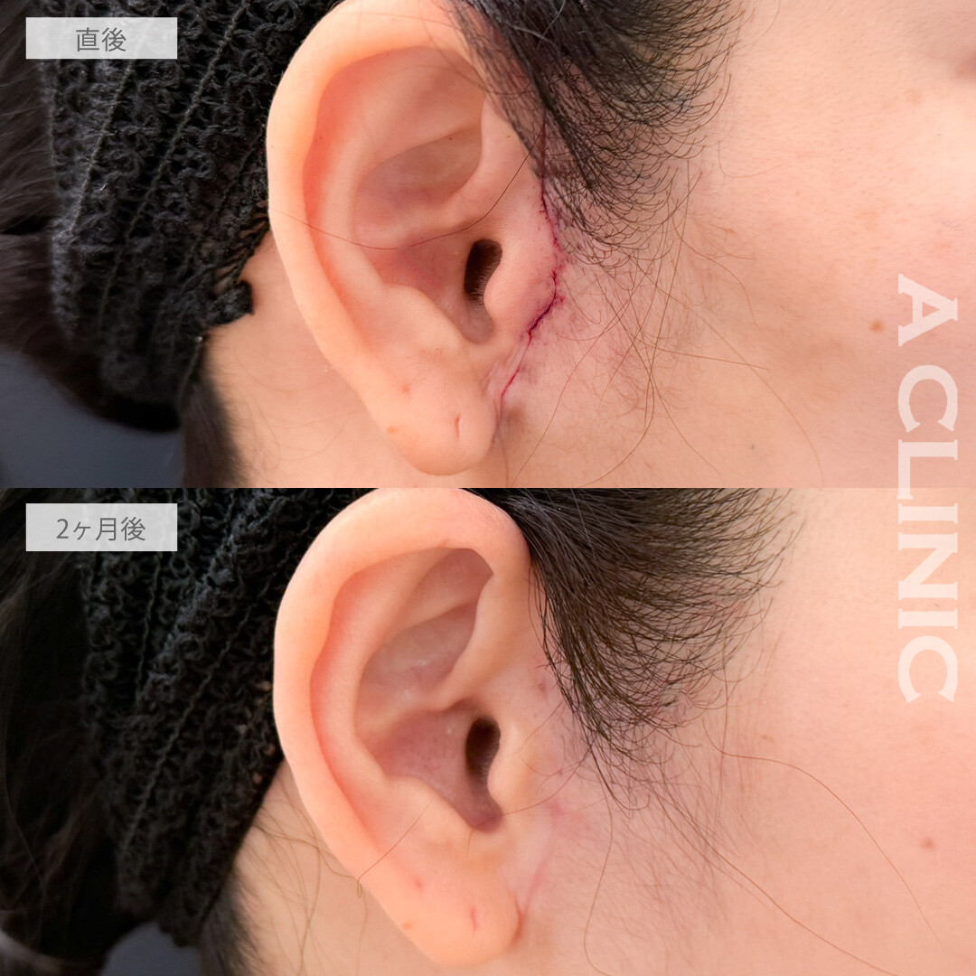 【直後の傷跡あり】A式美肌たるみ切開とPRP血小板療法でたるみをしっかり引き上げエイジングケア！こちら処置前と2か月後の症例です(40代女性)