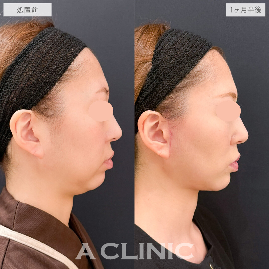 A式美肌たるみ切開と1day小顔脂肪吸引でたるみも脂肪も一掃できます！こちら処置前と1ヶ月半後の症例です(30代女性)