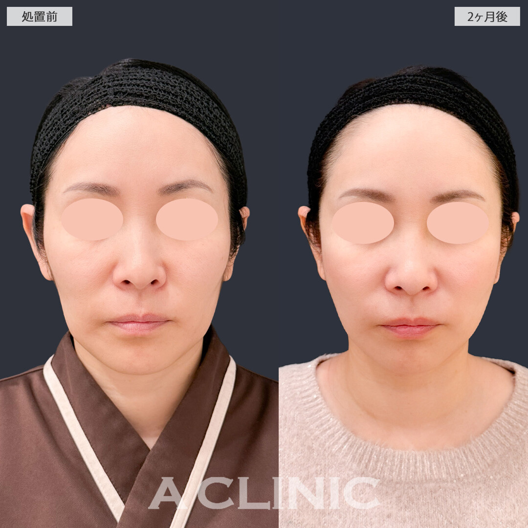 【直後の傷跡あり】A式美肌たるみ切開とPRP血小板療法でたるみをしっかり引き上げエイジングケア！こちら処置前と2か月後の症例です(40代女性)