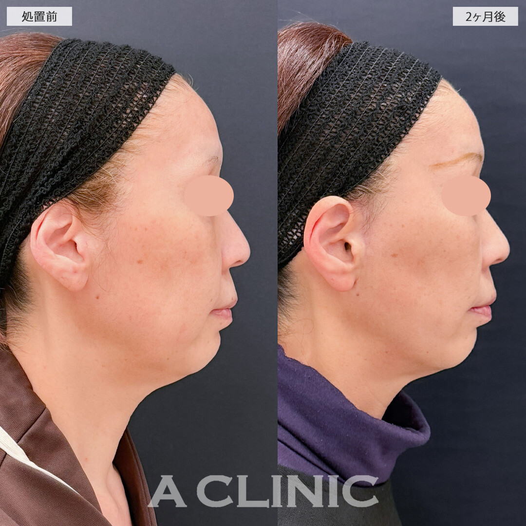 【直後の傷跡あり】A式美肌たるみ切開と1day小顔脂肪吸引でたるみも口横のポニョも改善されました！こちら処置前と2ヶ月後の症例です(50代女性)