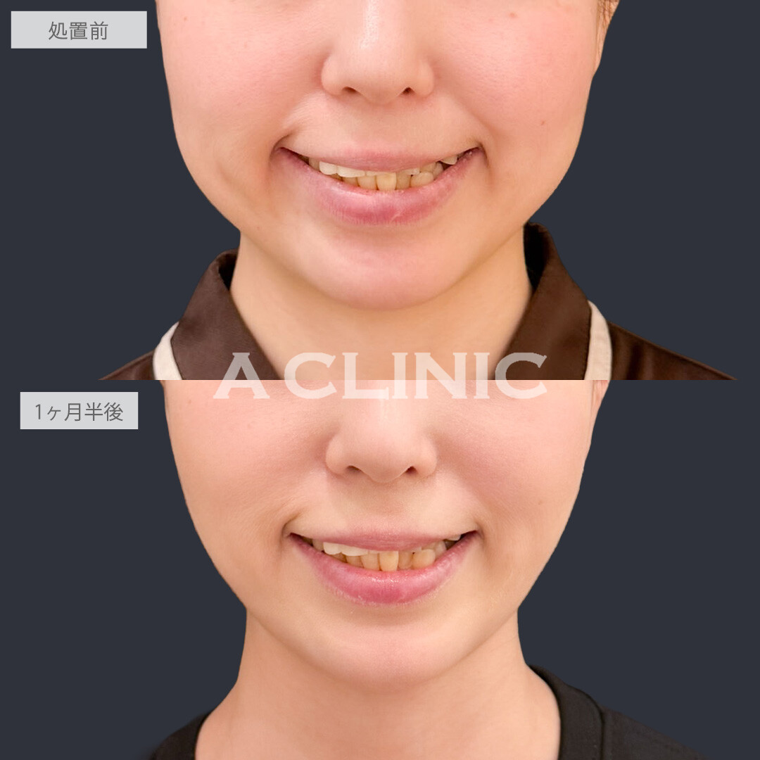 A式美肌たるみ切開と1day小顔脂肪吸引でたるみも脂肪も一掃できます！こちら処置前と1ヶ月半後の症例です(30代女性)