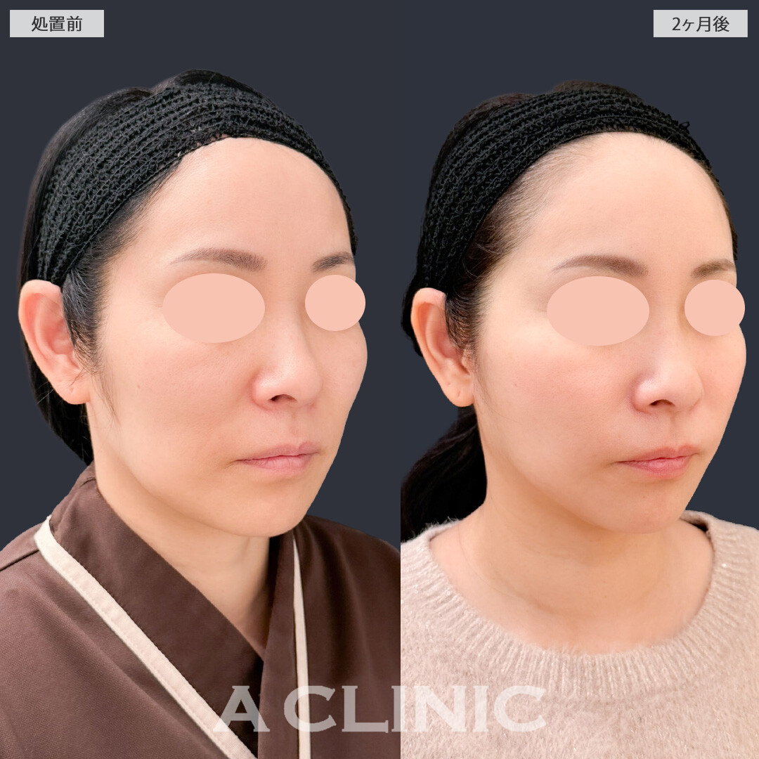 【直後の傷跡あり】A式美肌たるみ切開とPRP血小板療法でたるみをしっかり引き上げエイジングケア！こちら処置前と2か月後の症例です(40代女性)