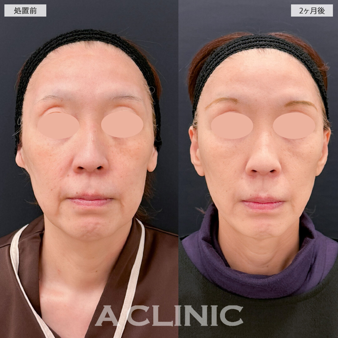 【直後の傷跡あり】A式美肌たるみ切開と1day小顔脂肪吸引でたるみも口横のポニョも改善されました！こちら処置前と2ヶ月後の症例です(50代女性)
