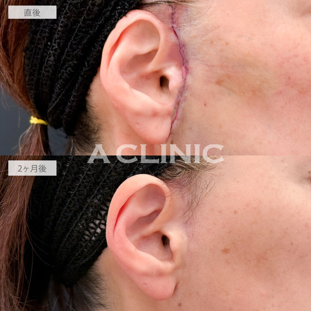 【直後の傷跡あり】A式美肌たるみ切開と1day小顔脂肪吸引でたるみも口横のポニョも改善されました！こちら処置前と2ヶ月後の症例です(50代女性)