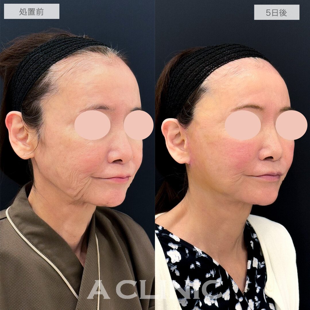 A式美肌たるみ切開で劇的に若返り！処置前と5日後の症例です(60代女性)