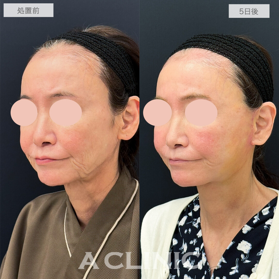 A式美肌たるみ切開で劇的に若返り！処置前と5日後の症例です(60代女性)