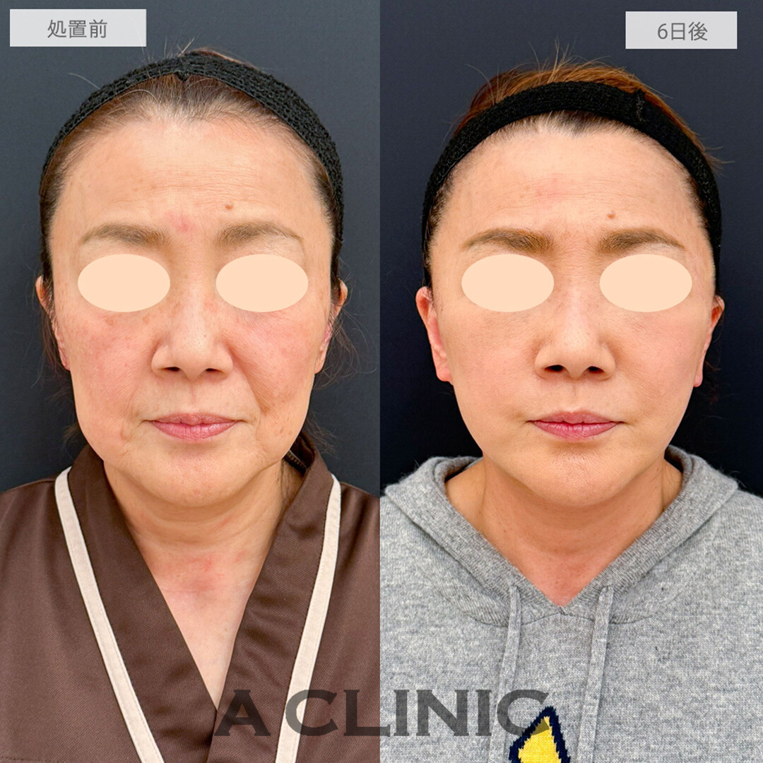 A式美肌たるみ切開と1day小顔脂肪吸引とグロースファクター注射で最強のアンチエイジング！処置前と6日後の症例です(60代女性)