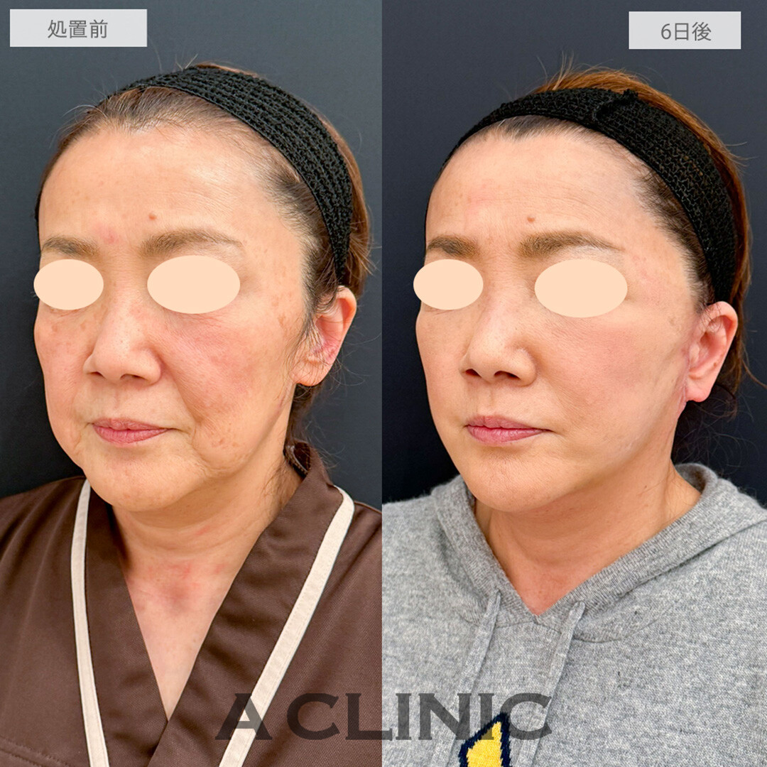 A式美肌たるみ切開と1day小顔脂肪吸引とグロースファクター注射で最強のアンチエイジング！処置前と6日後の症例です(60代女性)