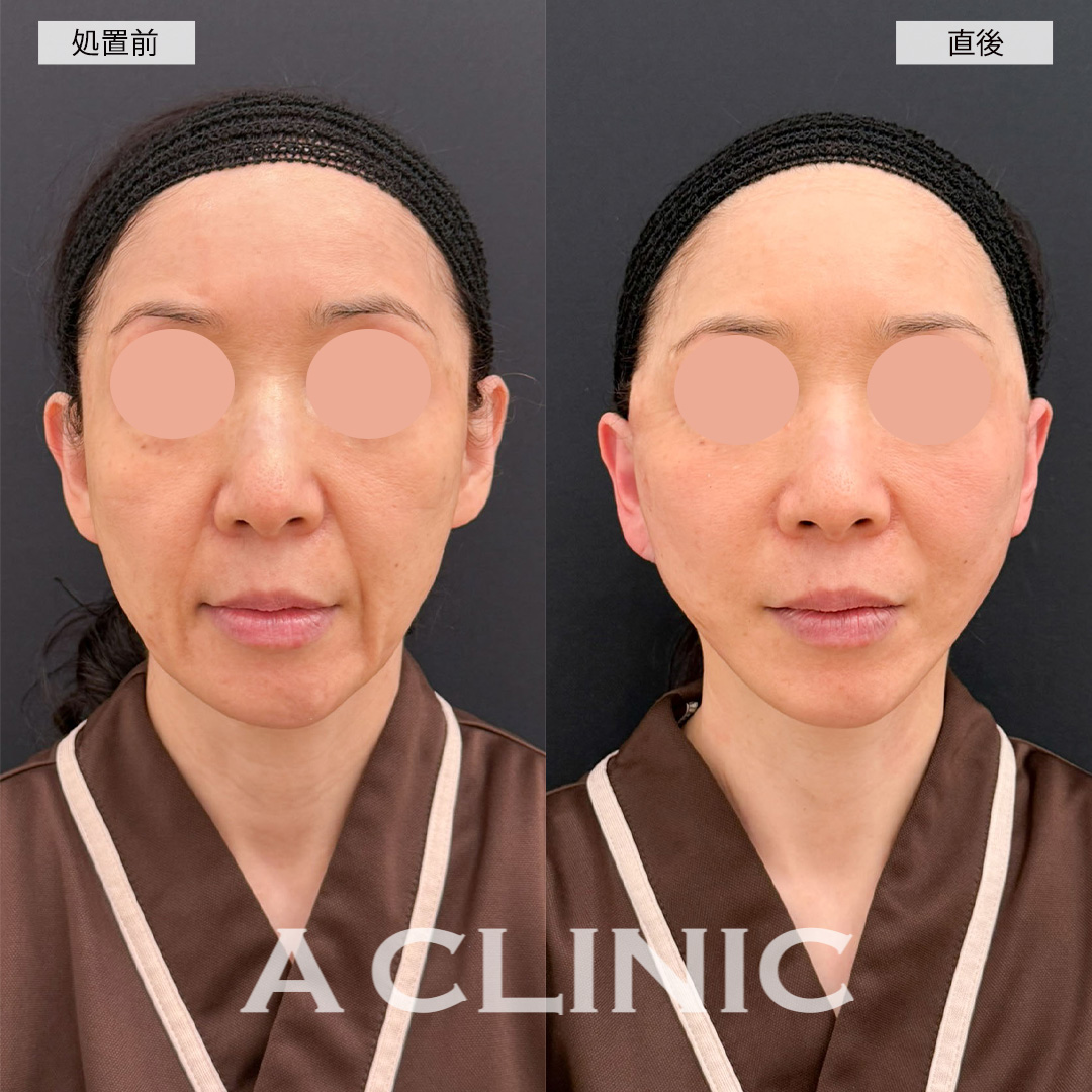 A式美肌たるみ切開は直後から腫れが最小限でシワを改善できます！こちら処置前と直後の症例です(50代女性)
