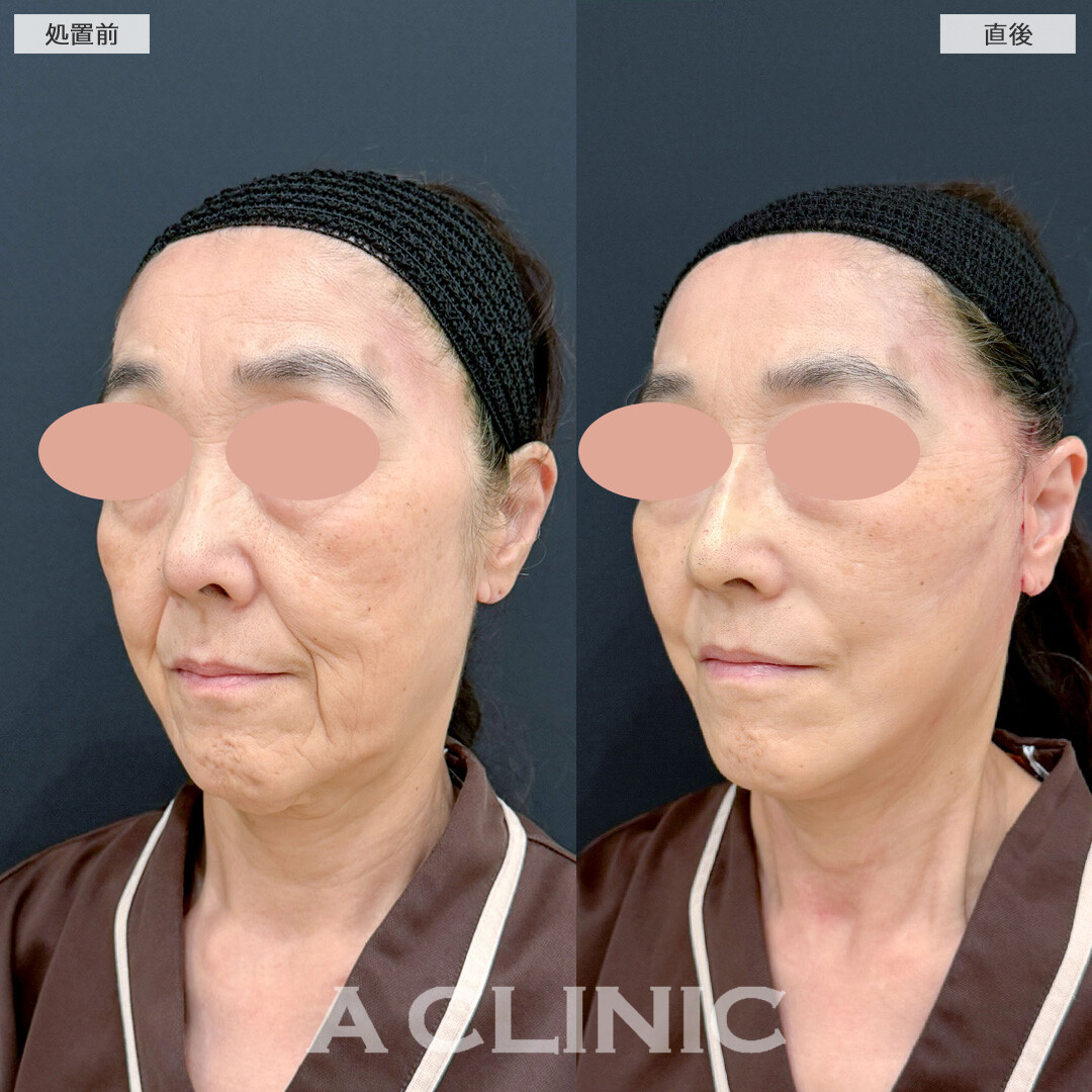 【直後の傷跡あり】A式美肌たるみ切開で少ないダウンタイムで強力リフトアップ！こちら処置前と処置直後の症例です(60代女性)