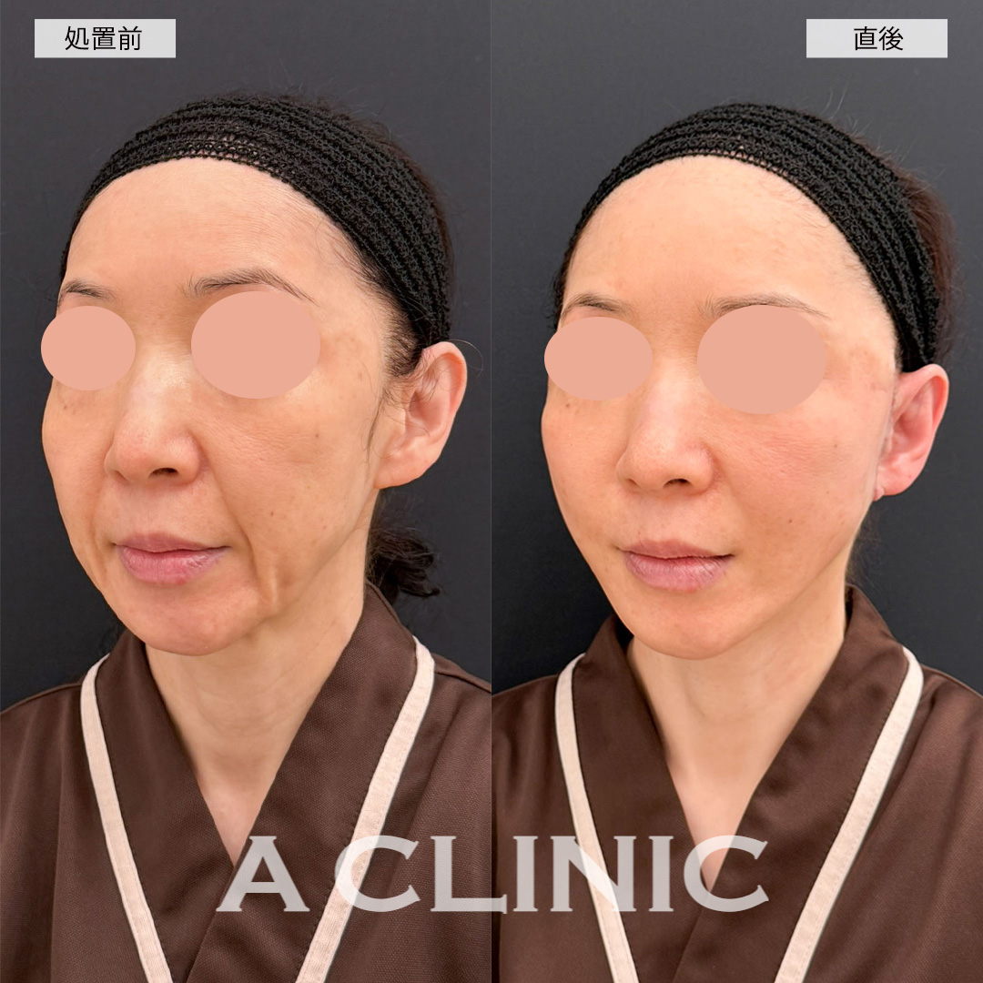 A式美肌たるみ切開は直後から腫れが最小限でシワを改善できます！こちら処置前と直後の症例です(50代女性)