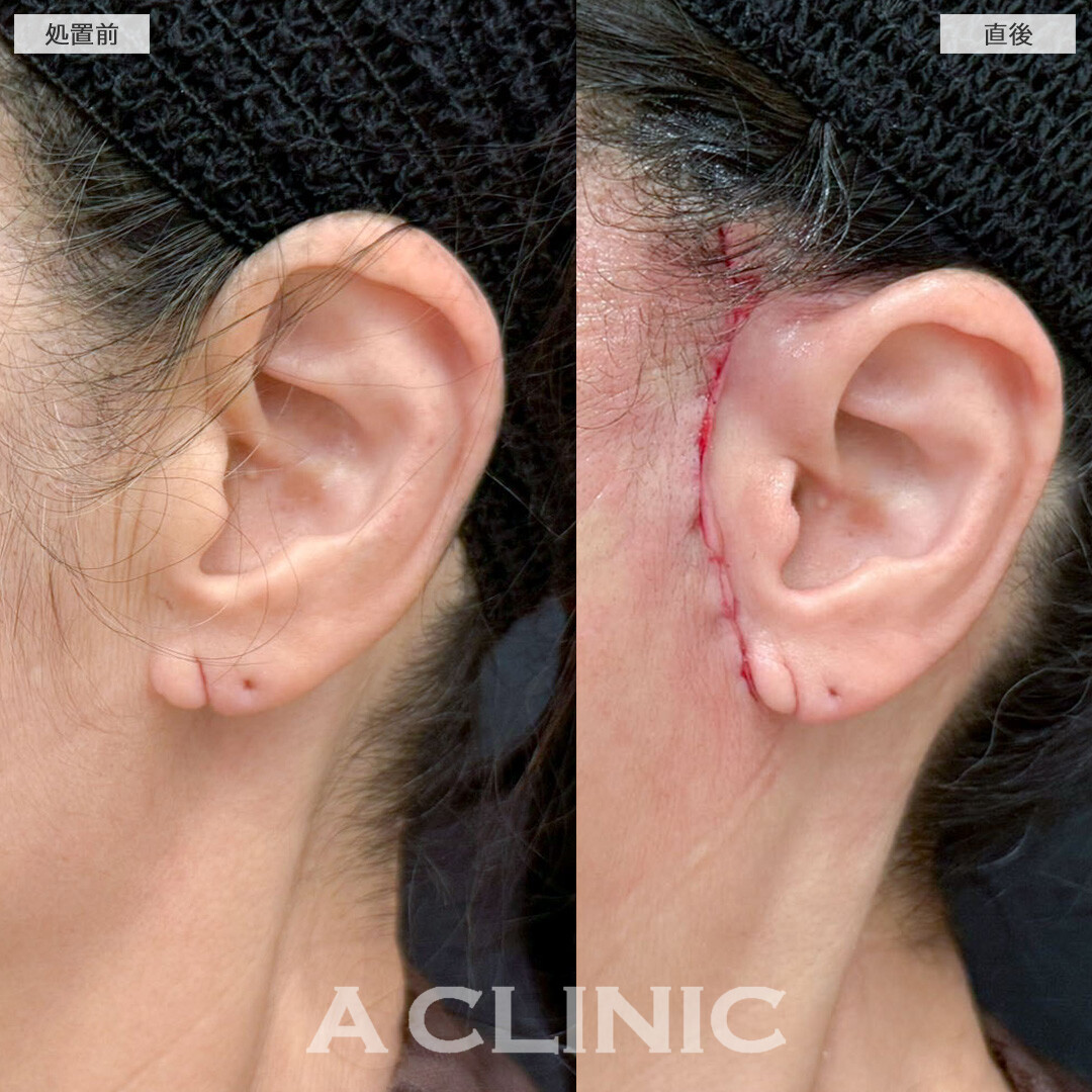 【直後の傷跡あり】A式美肌たるみ切開で少ないダウンタイムで強力リフトアップ！こちら処置前と処置直後の症例です(60代女性)