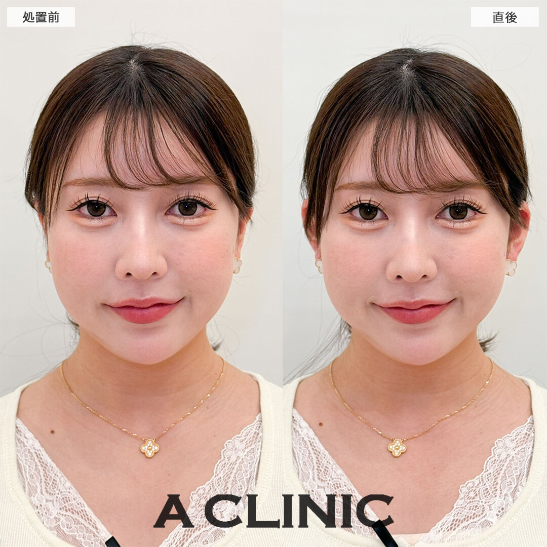立ち耳ヒアルロン酸注入(ボリューマ)は少しの変化で小顔効果抜群です！こちら処置前と直後の症例です(30代女性)