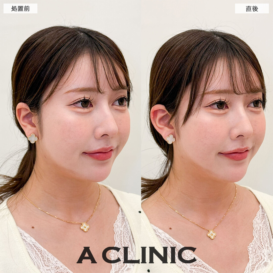 立ち耳ヒアルロン酸注入(ボリューマ)は少しの変化で小顔効果抜群です！こちら処置前と直後の症例です(30代女性)