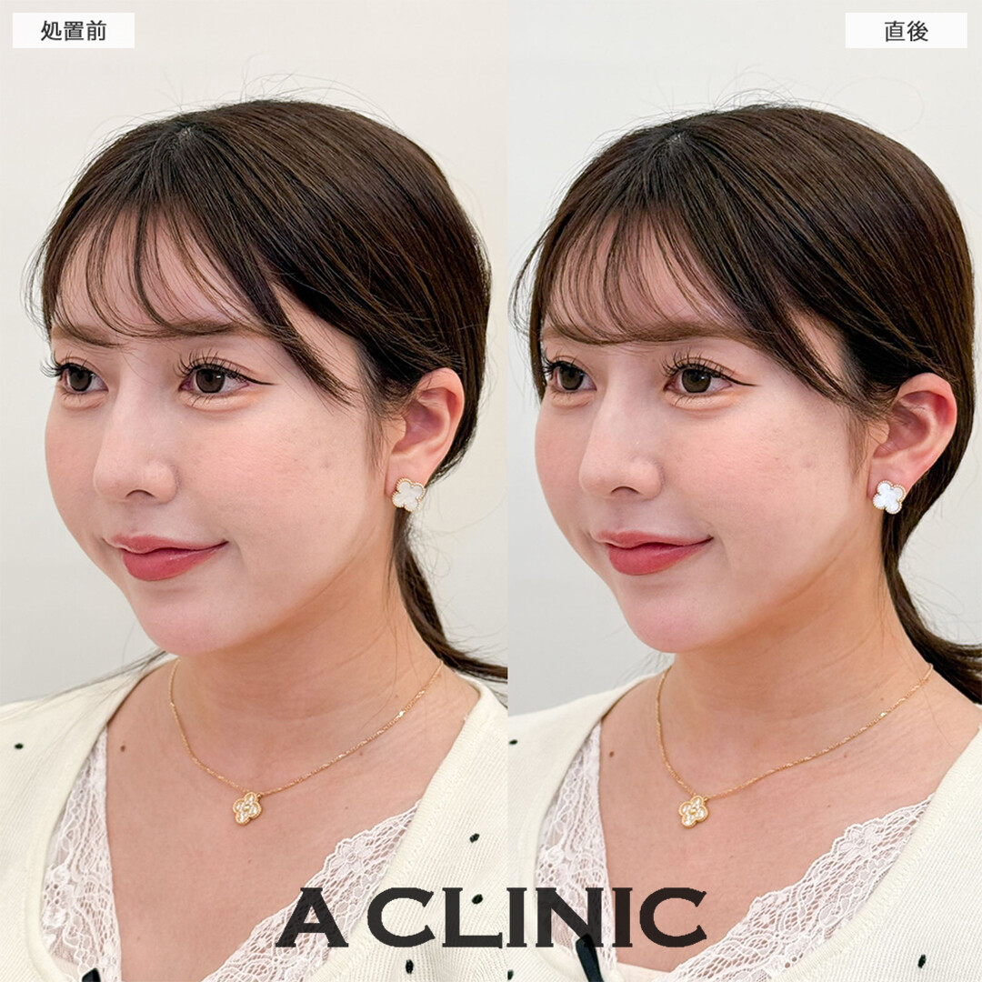 立ち耳ヒアルロン酸注入(ボリューマ)は少しの変化で小顔効果抜群です！こちら処置前と直後の症例です(30代女性)