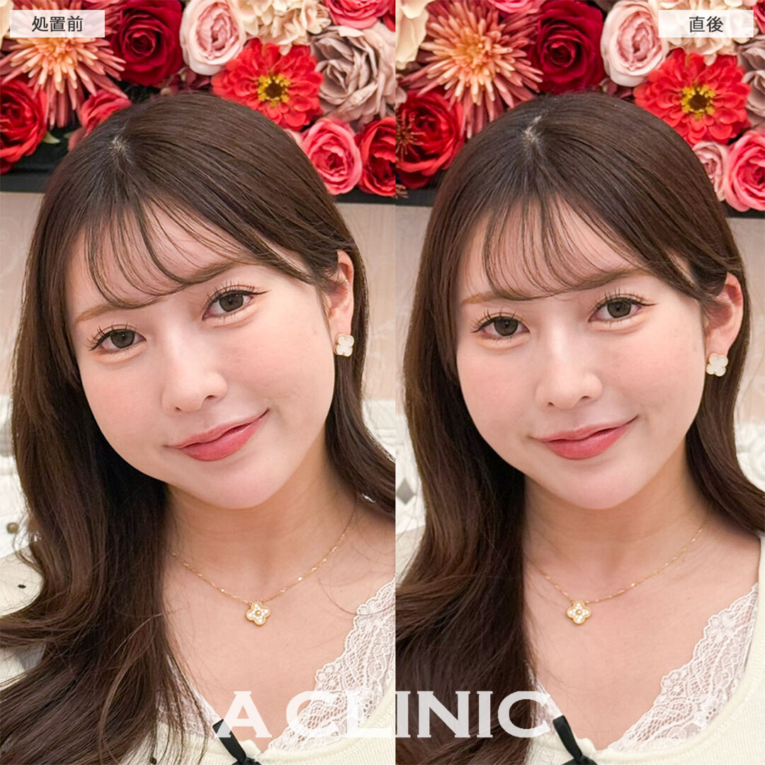 立ち耳ヒアルロン酸注入(ボリューマ)は少しの変化で小顔効果抜群です！こちら処置前と直後の症例です(30代女性)