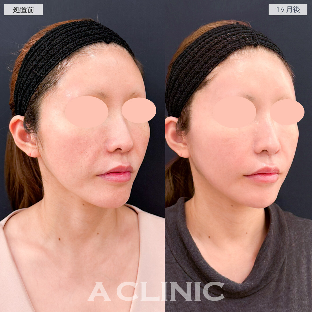 XERF(ザーフ)で肌を引き締め自然なリフトアップ効果を実感！処置前と1ヶ月後の症例です(40代女性)