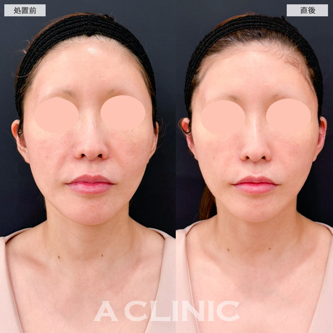 XERF(ザーフ)で直後からナチュラルだけどしっかりたるみ改善の効果を実感できました！処置前と直後の症例です(40代女性)