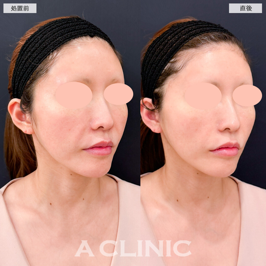 XERF(ザーフ)で直後からナチュラルだけどしっかりたるみ改善の効果を実感できました！処置前と直後の症例です(40代女性)