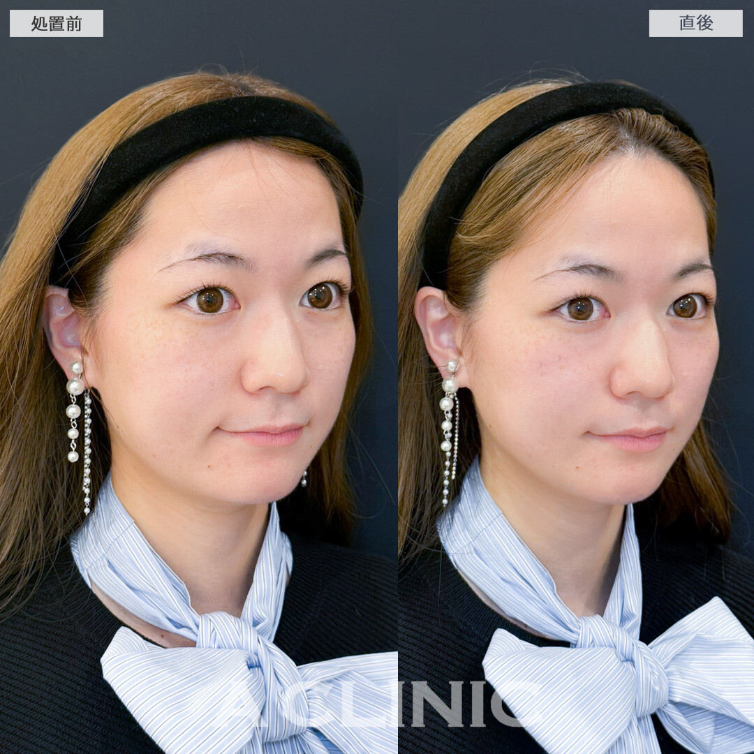 XERF(ザーフ)でフェイスラインのもたつきをナチュラルに改善できました！処置前と直後の症例です(20代女性)