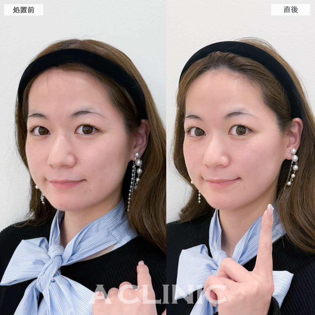 XERF(ザーフ)でフェイスラインのもたつきをナチュラルに改善できました！処置前と直後の症例です(20代女性)