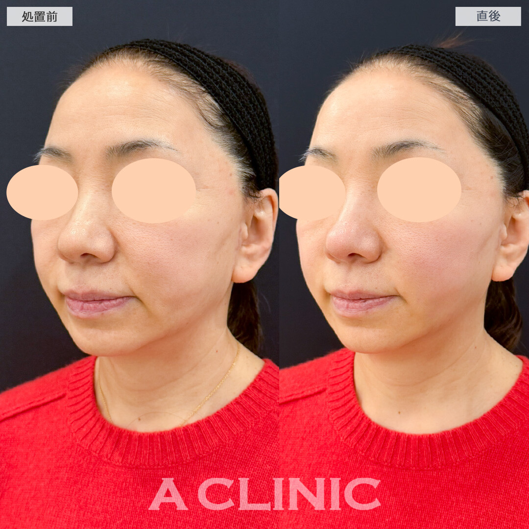 XERF(ザーフ)で肌が引き締まりたるみが目立たなくなりました！処置前と直後の症例です(60代女性)