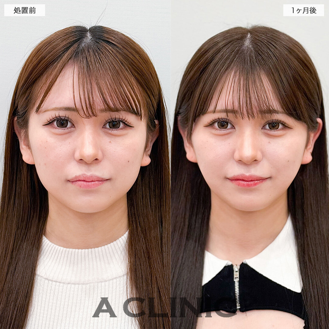 1day小顔脂肪吸引で加工不要のフェイスラインへ！こちら処置前と1ヶ月後の症例です(20代女性)