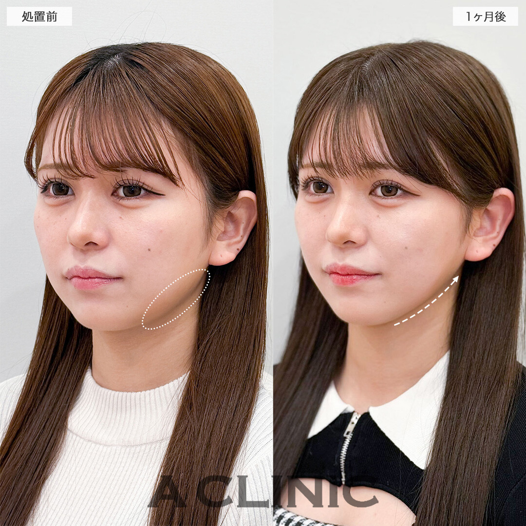 1day小顔脂肪吸引で加工不要のフェイスラインへ！こちら処置前と1ヶ月後の症例です(20代女性)