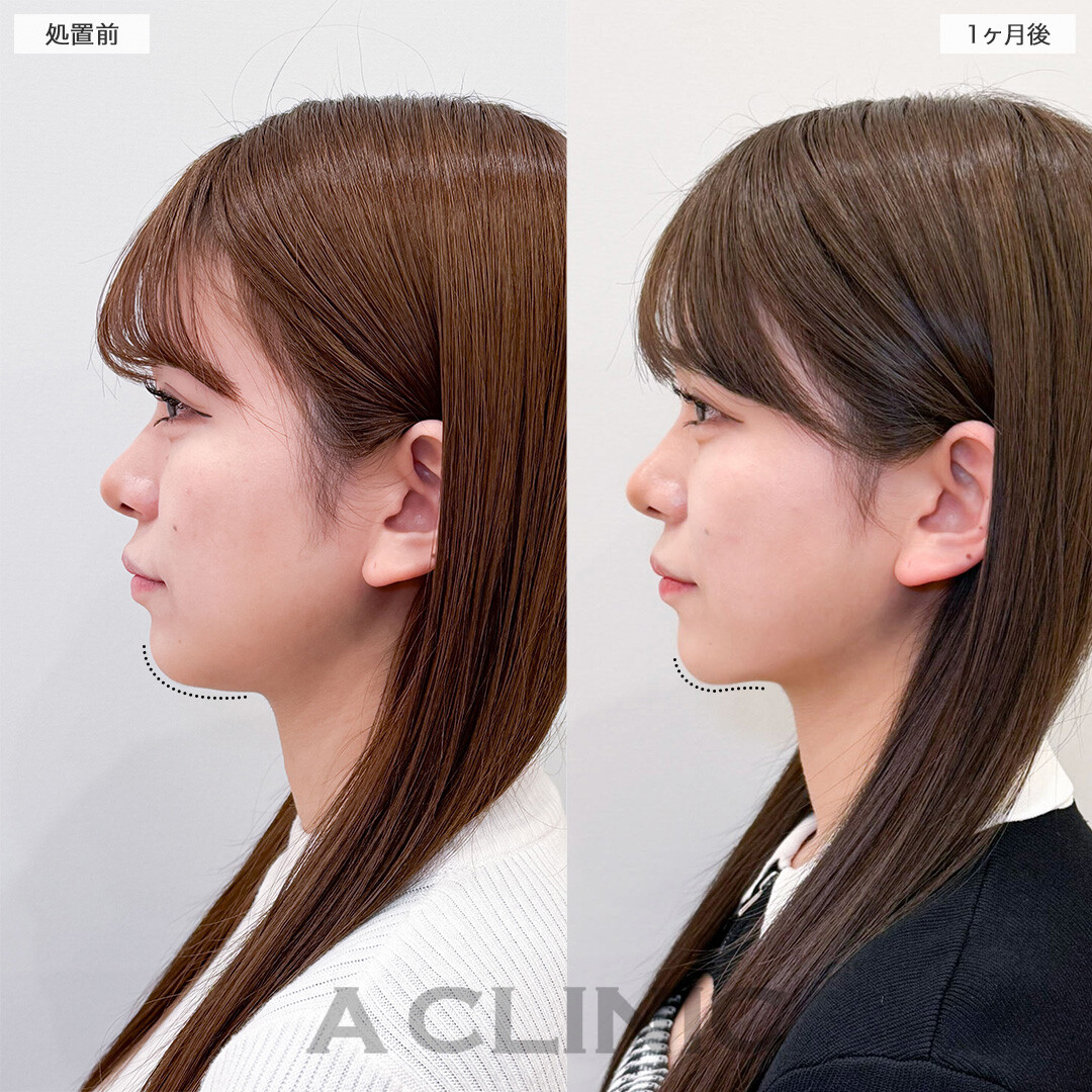 1day小顔脂肪吸引で加工不要のフェイスラインへ！こちら処置前と1ヶ月後の症例です(20代女性)