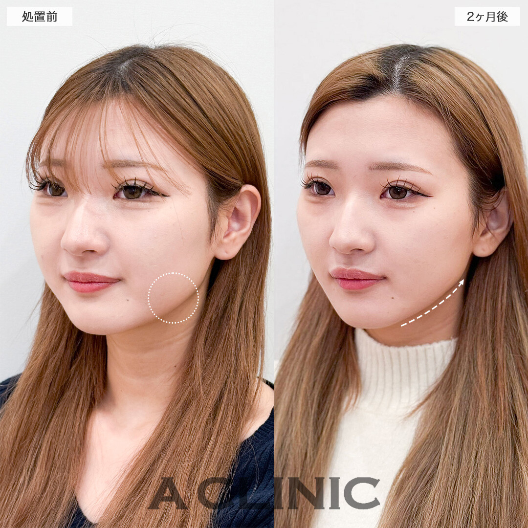1day小顔脂肪吸引で加工不要のフェイスラインへ！こちら処置前と2ヶ月後の症例です(20代女性)