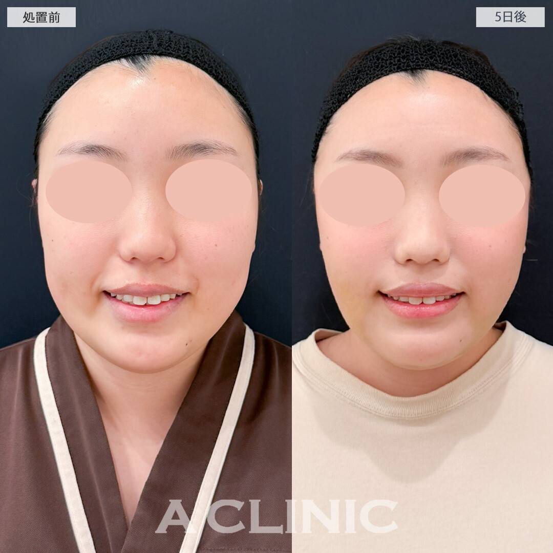 1day小顔脂肪吸引とバッカルファット除去術で術後もそこまで腫れが気にならずに過ごせました！処置前と5日後の症例です(20代女性)