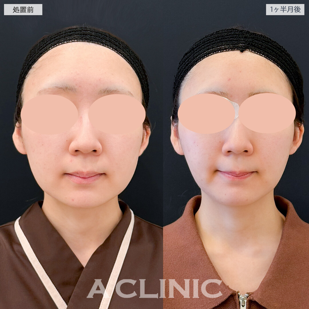 1day小顔脂肪吸引とバッカルファット除去術で不要なの脂肪のみ取り除き自分に似合う輪郭になれました！処置前と１ヶ月半後の症例です(20代女性)