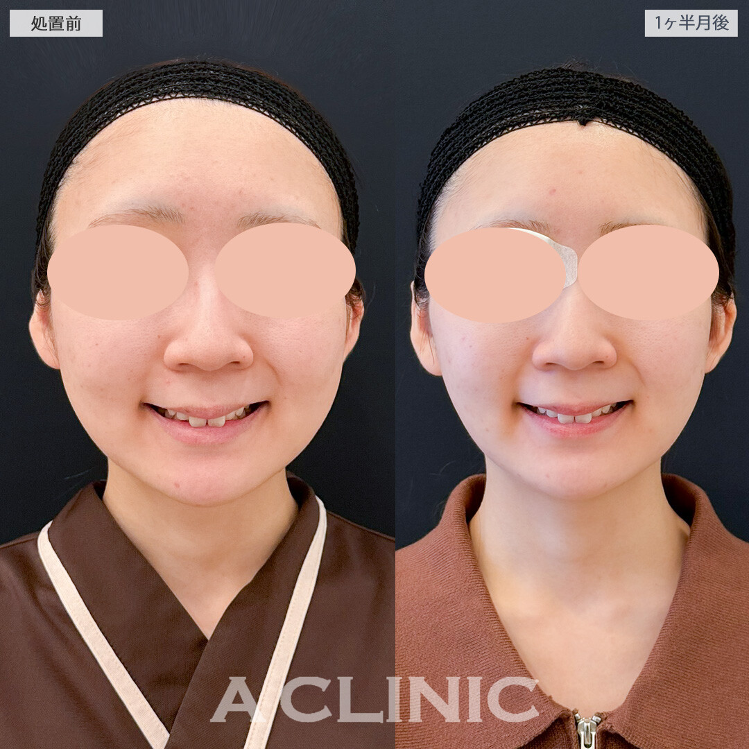 1day小顔脂肪吸引とバッカルファット除去術で不要なの脂肪のみ取り除き自分に似合う輪郭になれました！処置前と１ヶ月半後の症例です(20代女性)