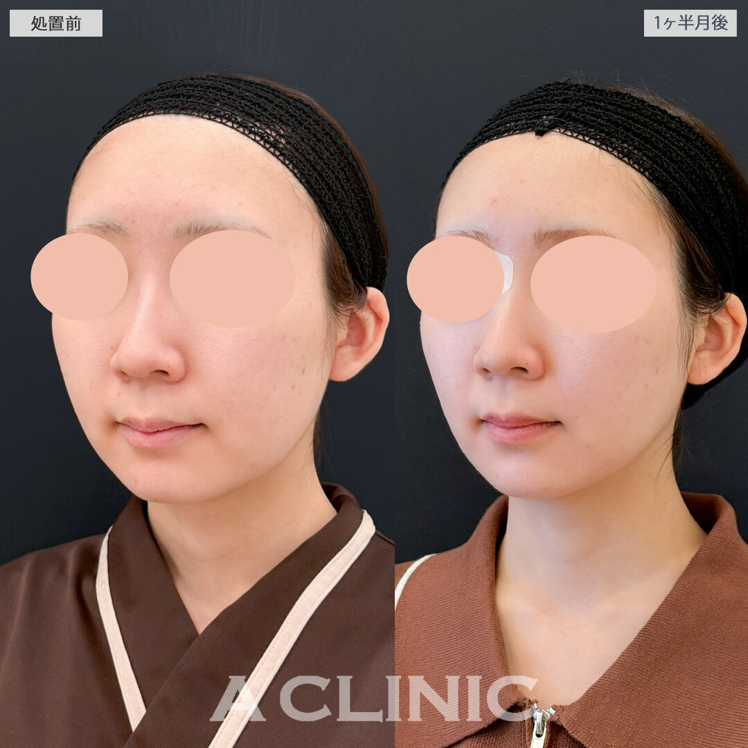 1day小顔脂肪吸引とバッカルファット除去術で不要なの脂肪のみ取り除き自分に似合う輪郭になれました！処置前と１ヶ月半後の症例です(20代女性)