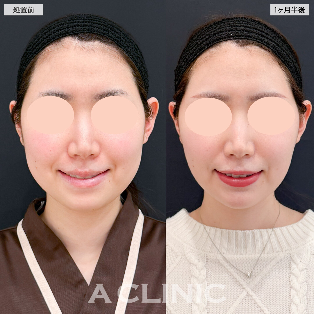 1day小顔脂肪吸引とバッカルファット除去術とあごへのヒアルロン酸注入でどの角度からも美しい輪郭に！処置前と1ヶ月半後の症例です(30代女性)