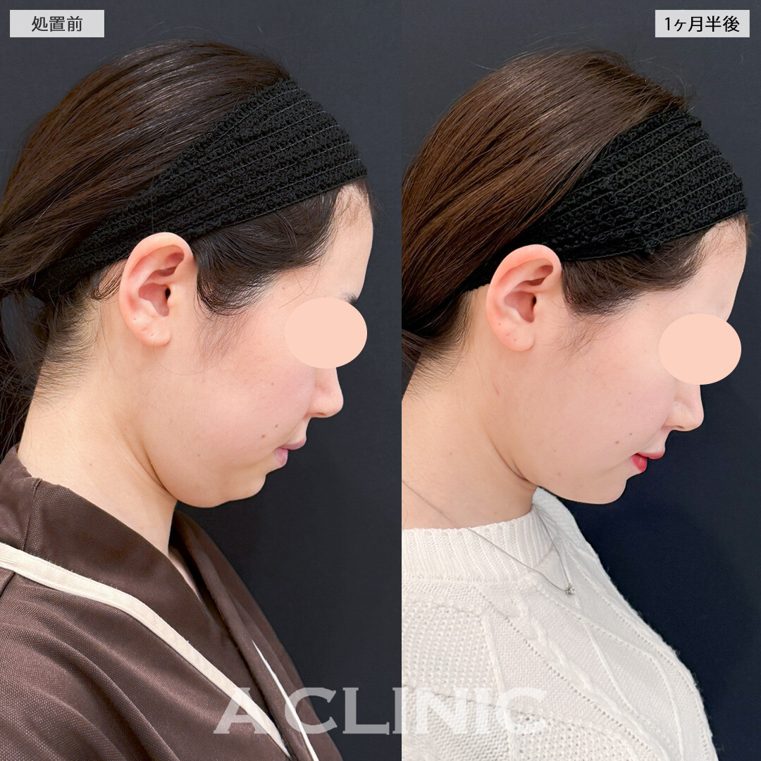 1day小顔脂肪吸引とバッカルファット除去術とあごへのヒアルロン酸注入でどの角度からも美しい輪郭に！処置前と1ヶ月半後の症例です(30代女性)