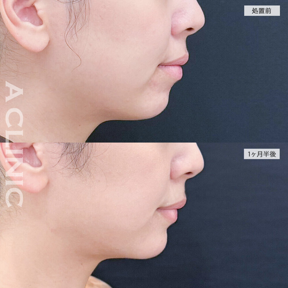 1day小顔脂肪吸引と小顔エラボトックスとあごへのヒアルロン酸注入でバランスの良い小顔に！こちら処置前と1ヶ月半後の症例です(30代女性)