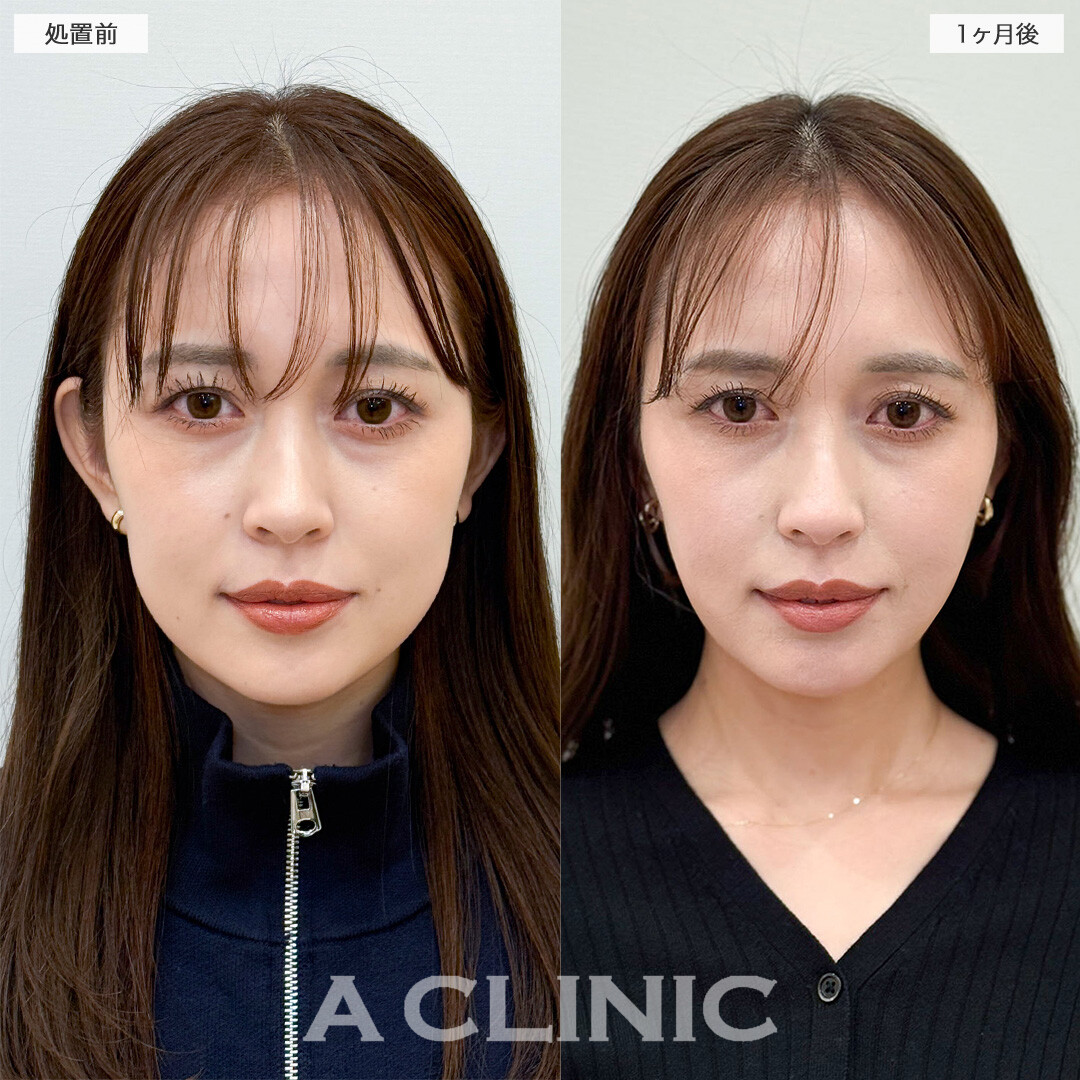1day小顔脂肪吸引とバッカルファット除去術で頬の膨らみを解消！こちら処置前と1ヶ月後の症例です(30代女性)
