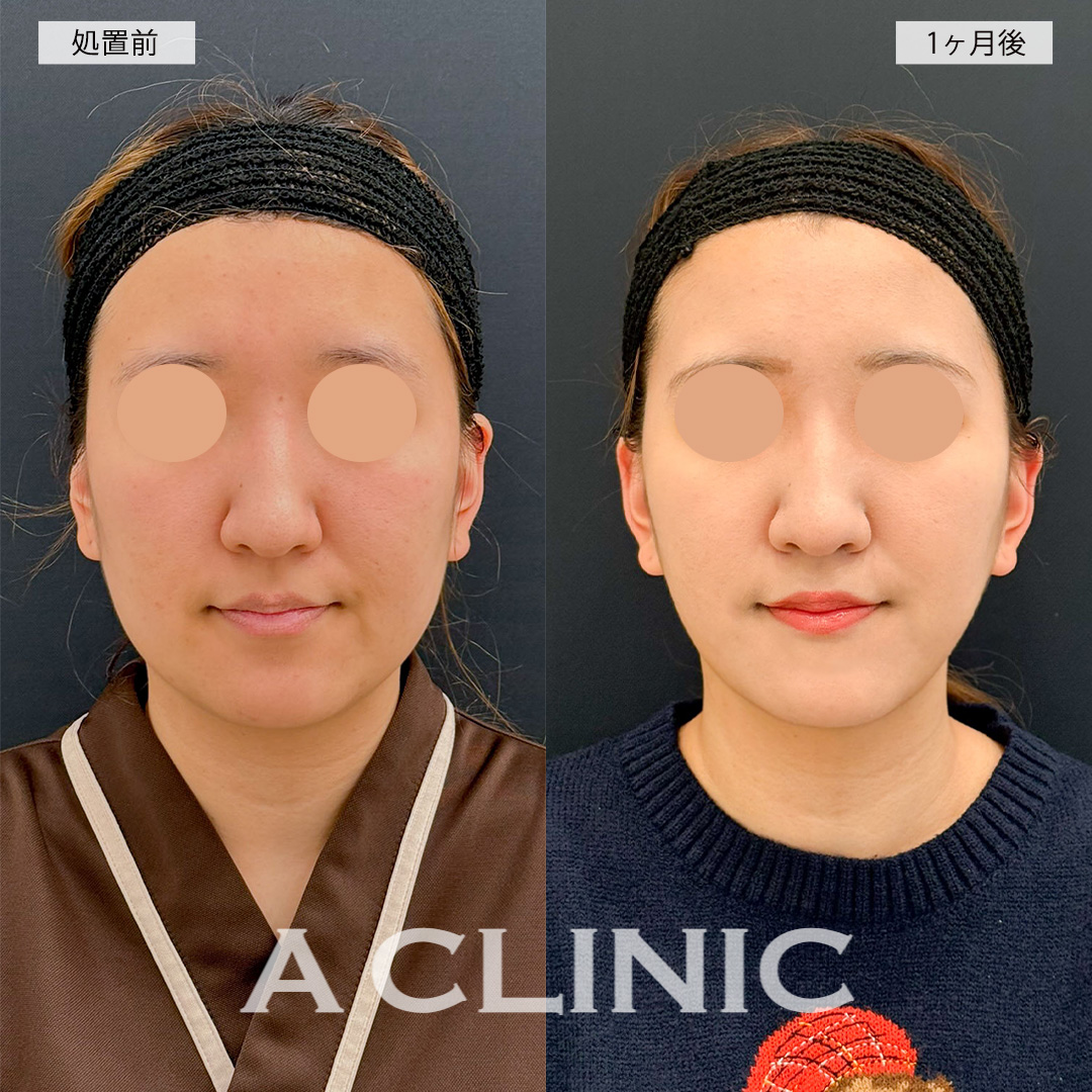 1day小顔脂肪吸引で輪郭のもたつきが無くなりダイエット無しでも痩せた印象に！こちら処置前と1ヶ月後の症例です(20代女性)