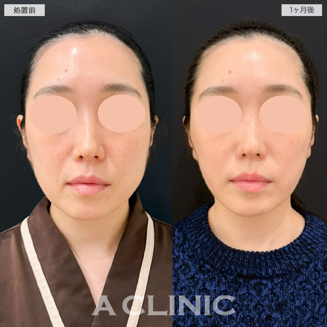 1day小顔脂肪吸引とナゾラビアルファット除去術でほうれい線が薄くなり若返り効果を実感！処置前と１ヶ月後の症例です(40代女性)