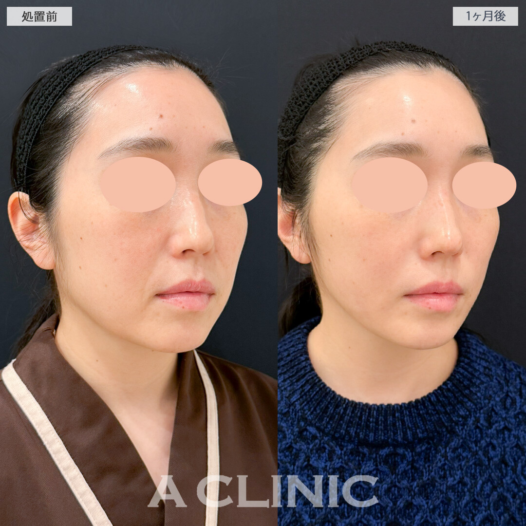 1day小顔脂肪吸引とナゾラビアルファット除去術でほうれい線が薄くなり若返り効果を実感！処置前と１ヶ月後の症例です(40代女性)