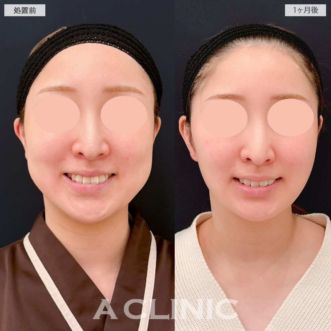 バッカルファット除去術で笑っても脂肪が目立たなくなりました！処置前と1ヶ月後の症例です(20代女性)