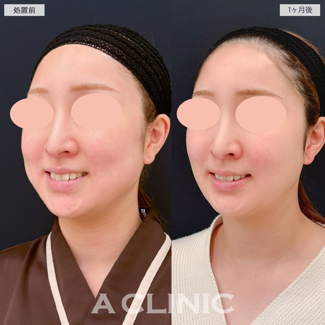 バッカルファット除去術で笑っても脂肪が目立たなくなりました！処置前と1ヶ月後の症例です(20代女性)