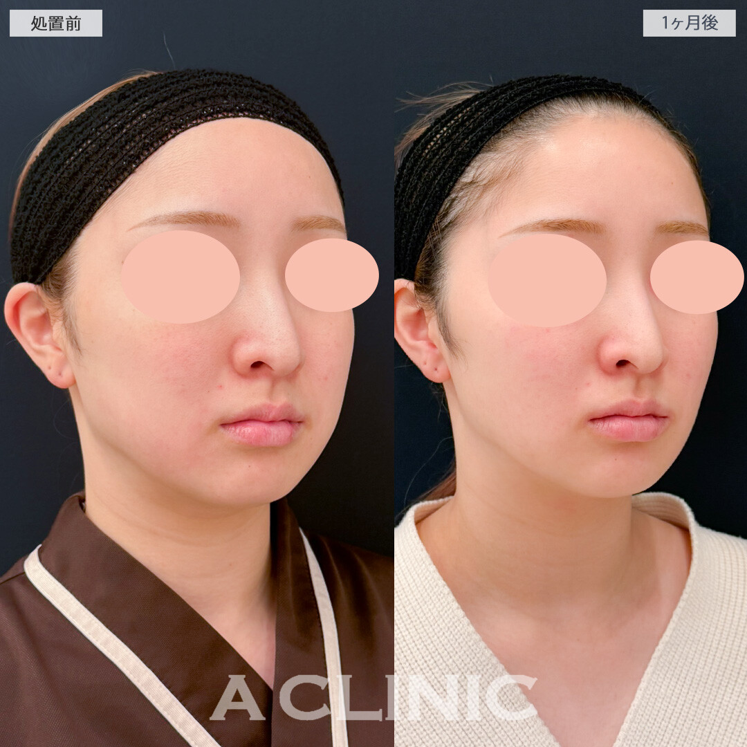 バッカルファット除去術で笑っても脂肪が目立たなくなりました！処置前と1ヶ月後の症例です(20代女性)
