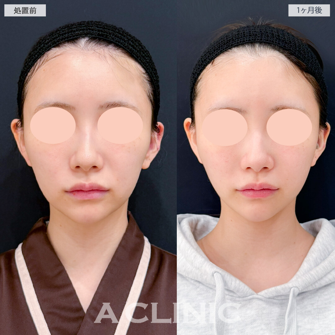 1day小顔脂肪吸引とグロースファクター注射でフェイスラインのもたつきやほうれい線が目立たなくなり疲れ顔解消でお人形さんのような輪郭に！処置前と1ヶ月後の症例です(20代女性)