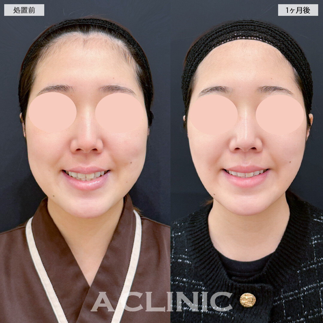 1day小顔脂肪吸引とバッカルファット除去術とナゾラビアルファット除去術で輪郭のボリュームを大幅にダウン！処置前と1ヶ月後の症例です(20代女性)