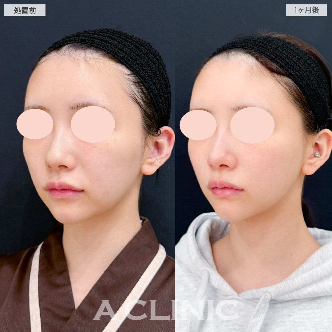 1day小顔脂肪吸引とグロースファクター注射でフェイスラインのもたつきやほうれい線が目立たなくなり疲れ顔解消でお人形さんのような輪郭に！処置前と1ヶ月後の症例です(20代女性)
